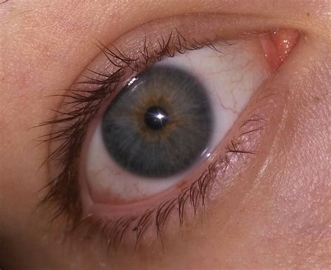[pics] Squiggly vessels and eye marks? : r/optometry