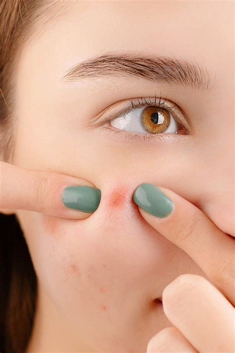 Pimples Photos, Download The BEST Free Pimples Stock Photos & HD Images