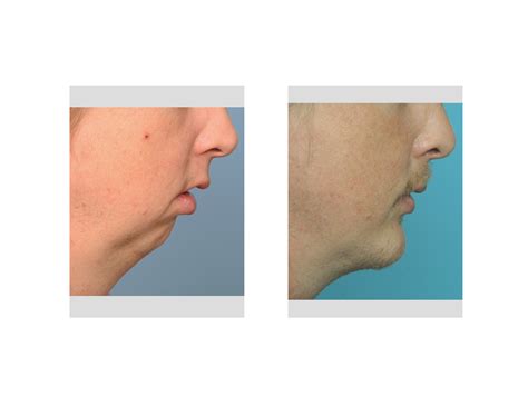 Butt Chin Surgery
