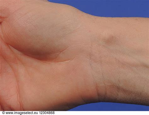 Synovial cyst of the wrist. Synovial cyst of the wrist.,Benign,Cystoid ...