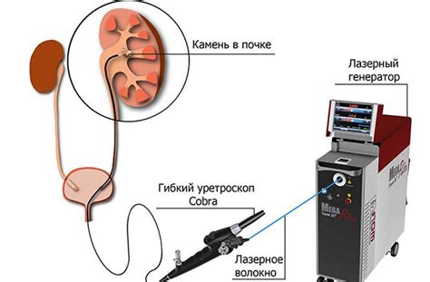 Удаление камней лазером