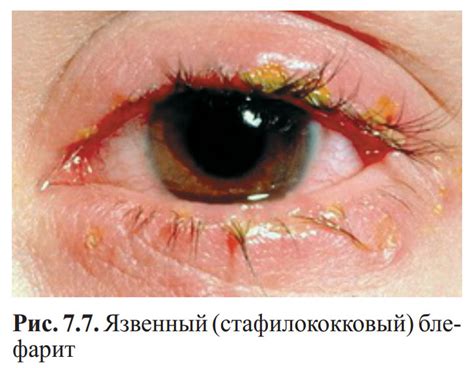 Глазные болезни. Учебник