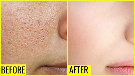 enlarged pores cheeks