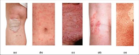 Different types of psoriasis: (a) Plaque psoriasis, (b) Guttate ...