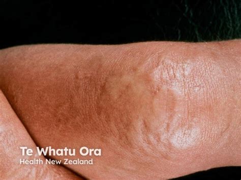 Diffuse cutaneous mastocytosis image