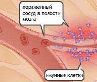 Церебральный васкулит :: Симптомы, причины, лечение и шифр по МКБ-10.