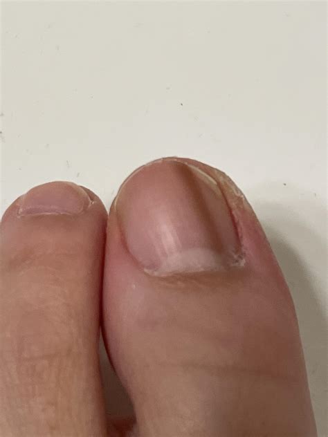 Brown line on big toenail : r/DermatologyQuestions