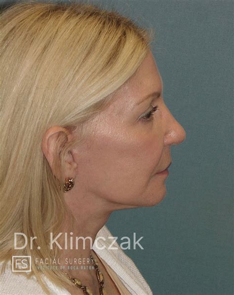 gallery facelift facial plastic surgery boca raton