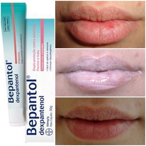 Pomada Para Labio Ressecado