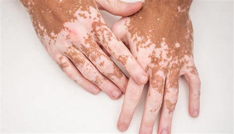 Pityriasis Alba Vs Vitiligo