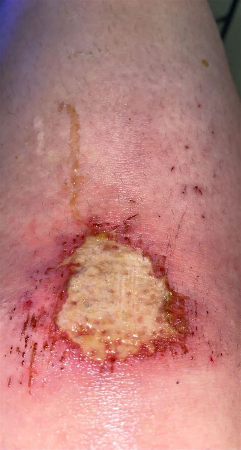 infected (i think) scrape on my knee that i got from tripping over my ...