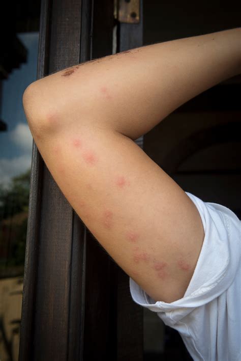 how to treat bedbugs bites 10