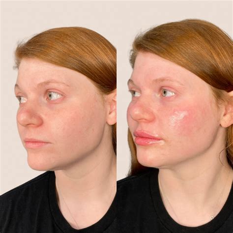 Do Lip Fillers Expire at Eden Goldfinch blog