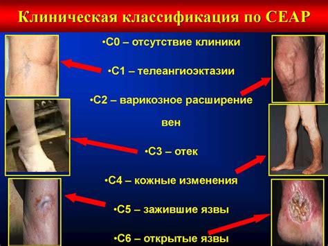 Варикозная болезнь нижних конечностей. Хроническая венозная ...