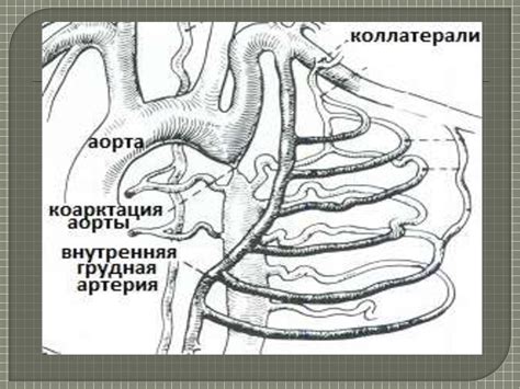 Коарктация аорты. Врожденная извитость аорты - презентация онлайн