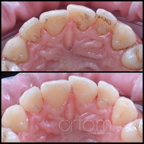 Професійна чистка зубів під мікросокопом - Ortom lounge dental clinic