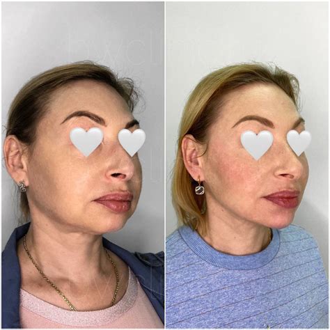 Процедуры инъекции липолитиков от 2490 руб/мл - BeautyWay Clinic 8 (499 ...