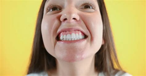 Gummy Smile Hakkında Bilmeniz Gerekenler - Zenit Dent