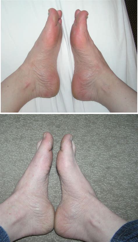 Hammer Toe Causes And Cures – gilmagebrayel