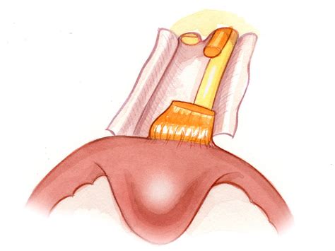 Microsurgery of Acoustic Neuroma-Translabyrinthine Approach | Jackler ...