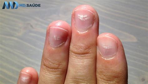 O Que Significa Manchas Brancas Nas Unhas - Leuconiquia: manchas brancas nas unhas