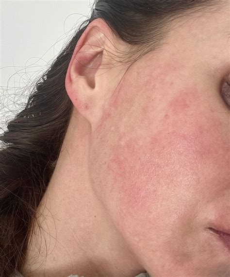 Yay cold weather running season is back : r/Rosacea