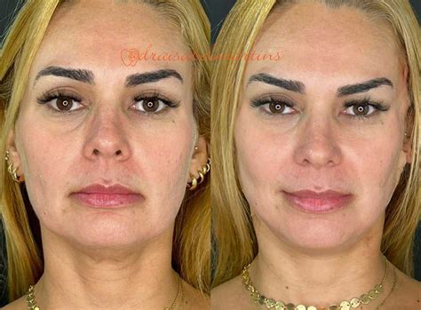 LIFTING FACIAL - CMA