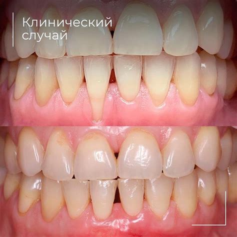 Корни зубов оголились после ортодонтии. Лечим рецессию десны | Георгий ...