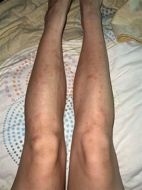 Allergy after lazer hair removal! : r/SkincareAddicts
