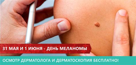 Меланома: Что нужно знать о меланоме и причинах ее развития?