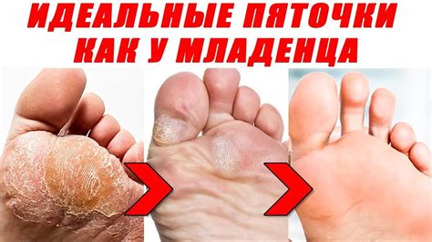 Гладкие пяточки. Что бы не трескались пятки испробуй этот рецепт. Может ...