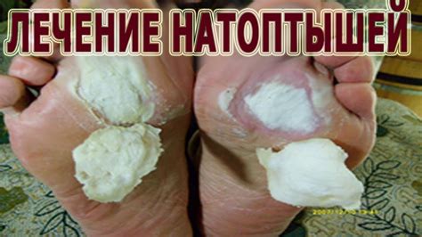 ★Методы лечения НАТОПТЫШЕЙ. Народные рецепты, которые ПОМОГАЮТ. - YouTube