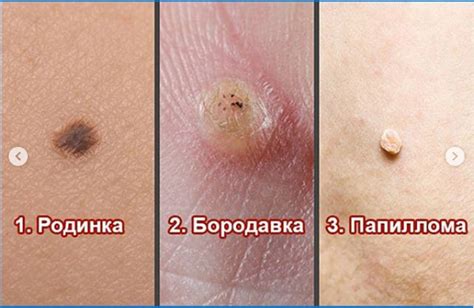 Кондиломы и папилломы
