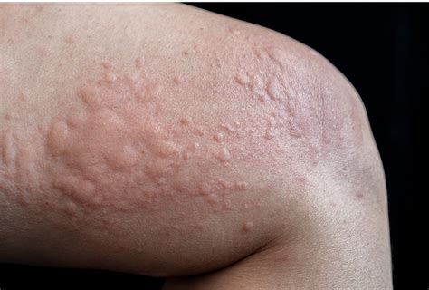 Itchy Skin Allergy