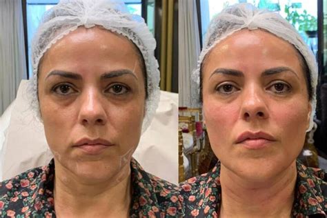 Radiesse Deixa O Rosto Gordo - Antes E Depois Do Radiesse: Resultados Reais E Duradouros Em 2026