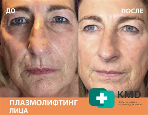 Плазмолифтинг лица, суть процедуры, отзывы, результаты и фото