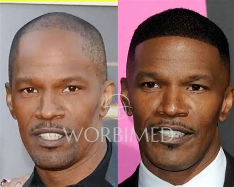 Jamie Foxx Hair Transplant l Before and After