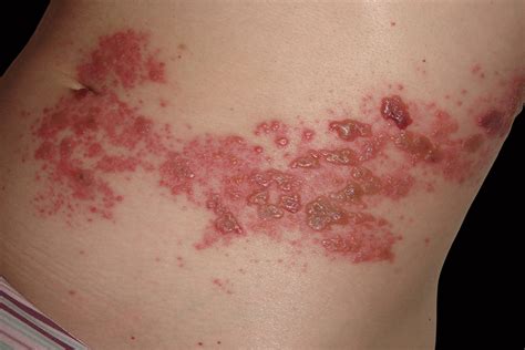 Shingles: A Complete Guide for Clinicians - Clinical Advisor