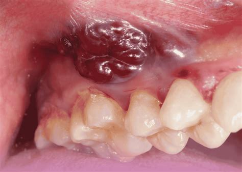 Advanced Oral Cavity Cancer: Complex Surgical Management with