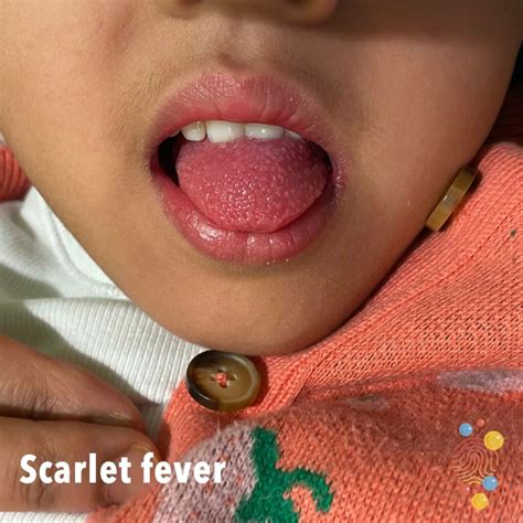 Scarlet fever - Skin Deep