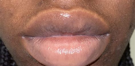 Weird lip rash : r/SkincareAddicts