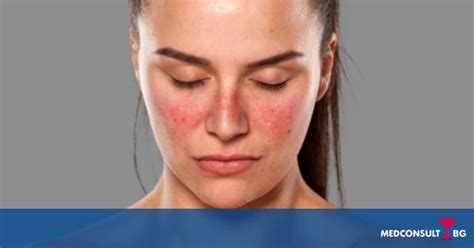 По какъв начин се проявява лупусът — MedConsult.bg