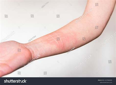 Dermographia Images, Stock Photos & Vectors | Shutterstock
