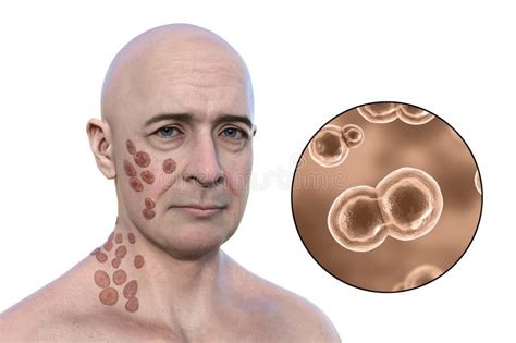 A Man with Cutaneous Blastomycosis, 3D Illustration Stock Illustration ...