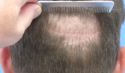 Do Hair Transplants Hurt | What To expect After Surgery