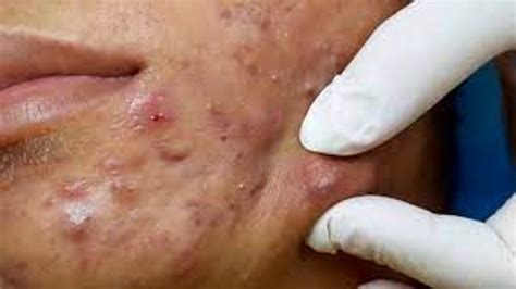 Latest Blackhead Popping Crazy Huge And Pimple Best Pimple