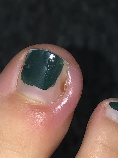 how to cut toenails to avoid ingrown nail 11