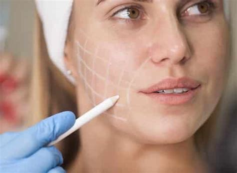 face fillers clinetix