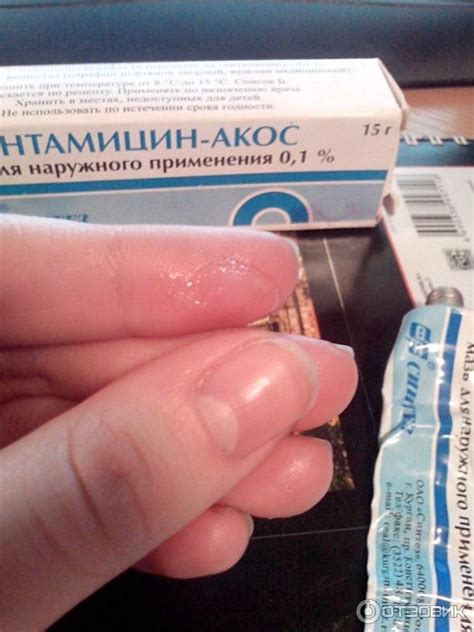 Furunculosis antibiotic treatment