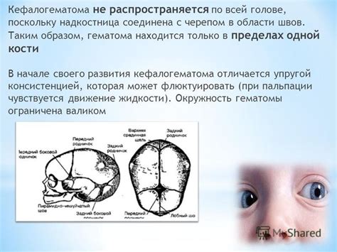 Презентация на тему: "Скребейко П.И. ЛД-131 Кефалогематома у ...